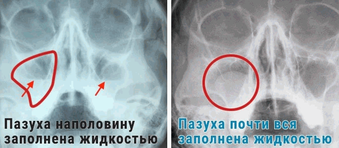 Гайморит на снимке-2.png Гайморит на снимке-2.png