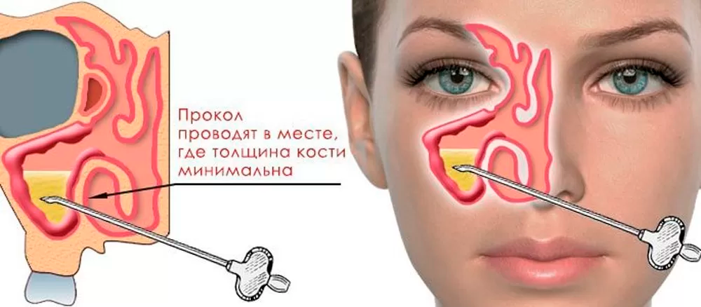 Прокол при гайморите-2.png Прокол при гайморите-2.png