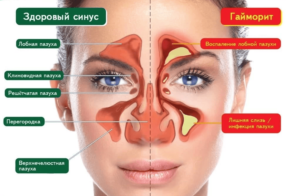 Гайморит без насморка-1 (1).png Гайморит без насморка-1 (1).png